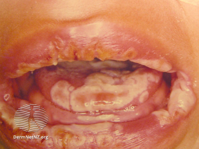 File:(DermNet NZ herpes-simplex-labialis-31).jpg