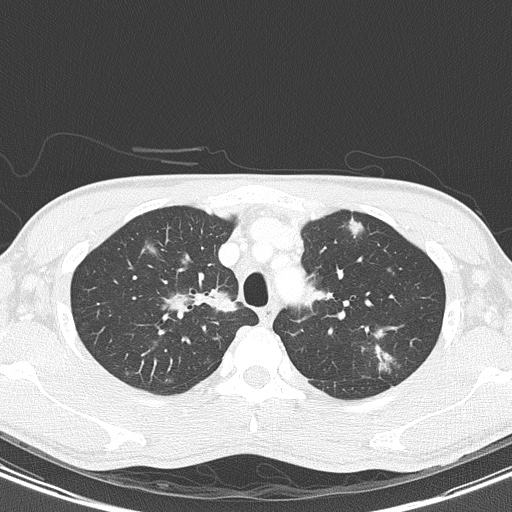 File:AIDS-related Kaposi sarcoma (Radiopaedia 85247-100811 Axial lung window 38).jpg