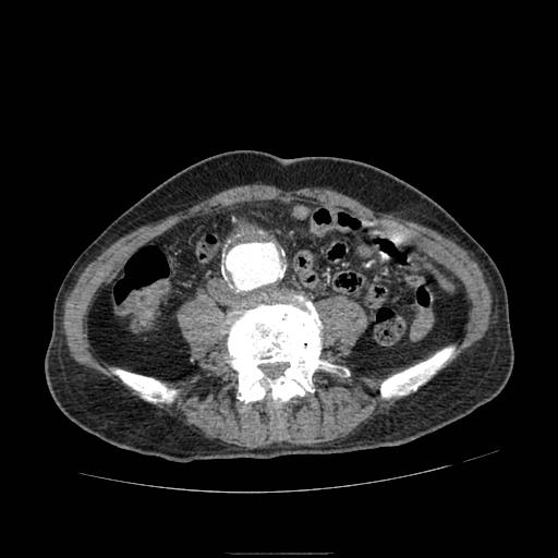 Abdominal aortic aneurysm (Radiopaedia 13341-13340 Axial C+ arterial phase 140).jpg