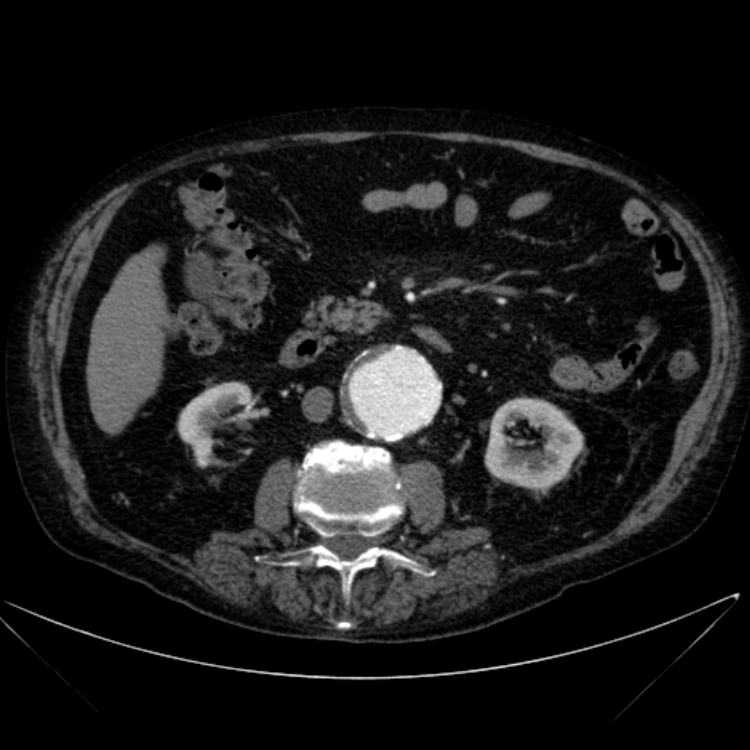 Abdominal aortic aneurysm (Radiopaedia 25855-26001 Axial C+ arterial phase 61).jpg