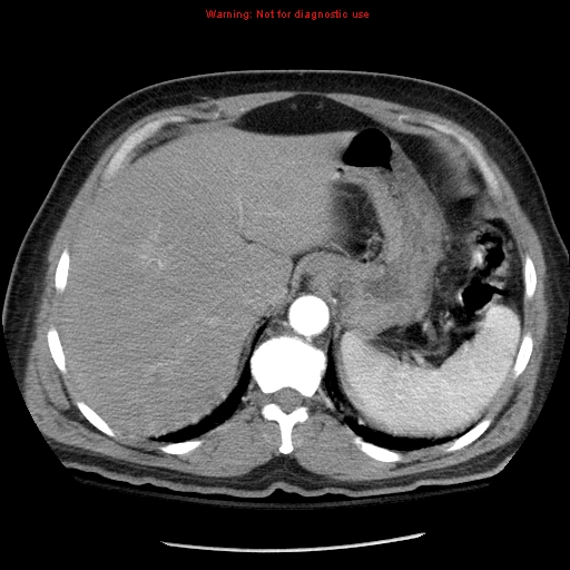 Abdominal aortic aneurysm (Radiopaedia 8190-9038 Axial C+ arterial phase 16).jpg