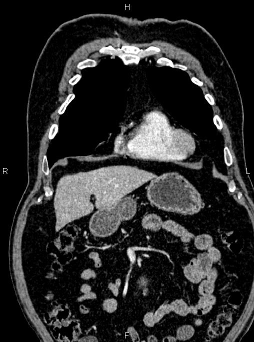 Abdominal aortic aneurysm (Radiopaedia 83094-97462 Coronal renal cortical phase 30).jpg