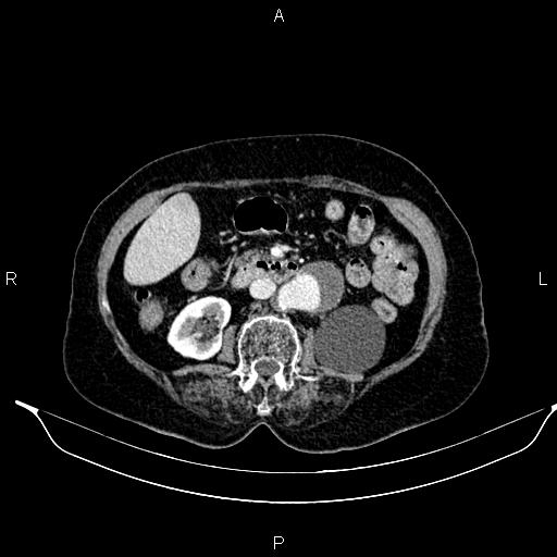 File:Abdominal aortic aneurysm (Radiopaedia 85063-100606 Axial C+ portal venous phase 39).jpg