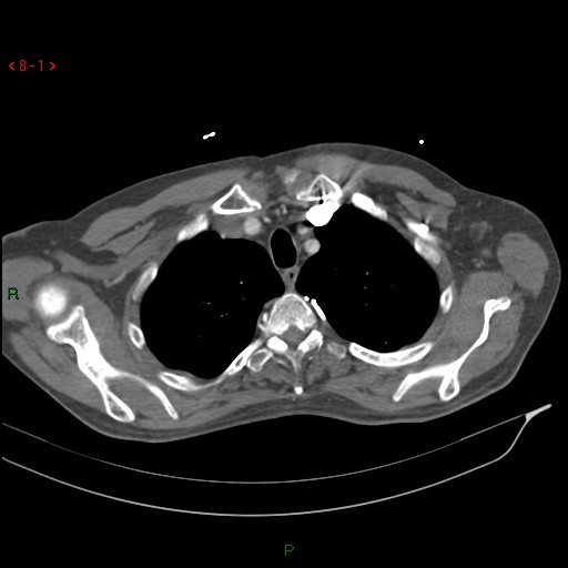 File:Abdominal aortic aneurysm rupture with aortocaval fistula (Radiopaedia 14897-14841 Axial C+ arterial phase 1).jpg
