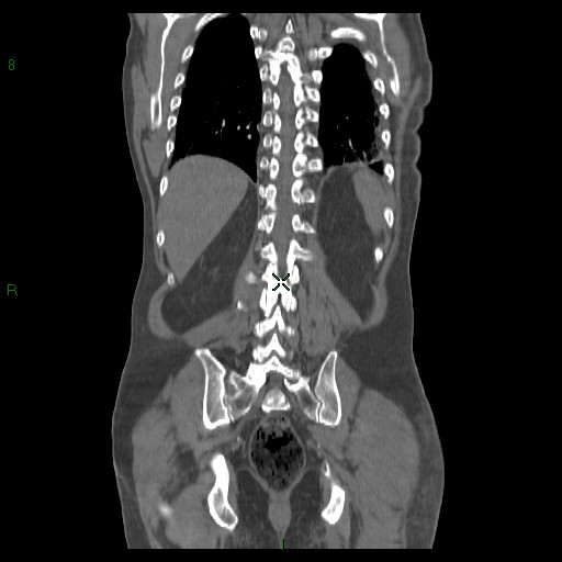 File:Abdominal aortic aneurysm rupture with aortocaval fistula (Radiopaedia 14897-14841 Coronal C+ arterial phase 34).jpg