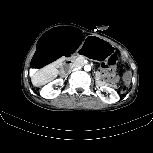File:Abdominal collection due to previous cecal perforation (Radiopaedia 80831-94320 Axial C+ portal venous phase 79).jpg