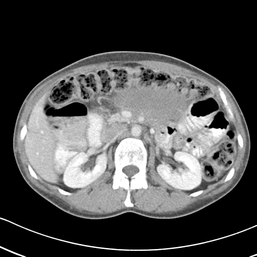 File:Abdominal desmoid tumor (Radiopaedia 41007-43740 Axial C+ portal venous phase 22).png