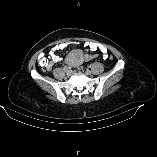 File:Abdominal lymphoma with sandwich sign (Radiopaedia 84378-99704 Axial C+ portal venous phase 42).jpg