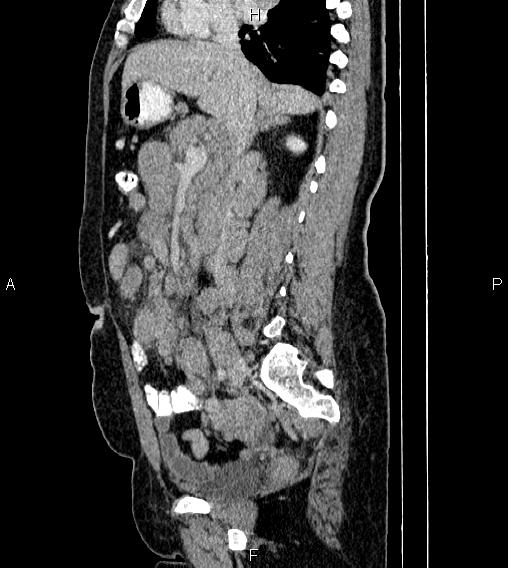 Abdominal lymphoma with sandwich sign (Radiopaedia 84378-99704 Sagittal C+ portal venous phase 37).jpg