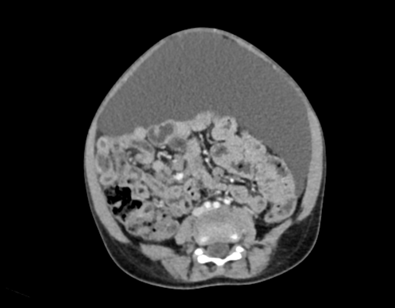 Abdominal premesenteric cystic lymphangioma (Radiopaedia 82995-97350 Axial C+ portal venous phase 38).jpg