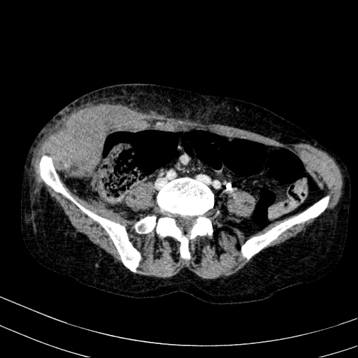 Abdominal wall hematoma with active bleeding (Radiopaedia 83915-99117 Axial C+ portal venous phase 80).jpg