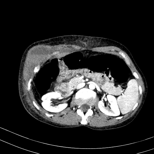 Abdominal wall hematoma with active bleeding (Radiopaedia 83915-99117 Axial renal cortical phase 19).jpg