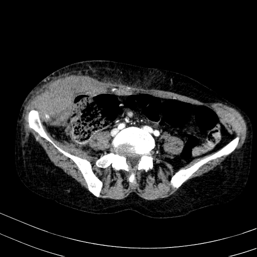 Abdominal wall hematoma with active bleeding (Radiopaedia 83915-99117 Axial renal cortical phase 81).jpg