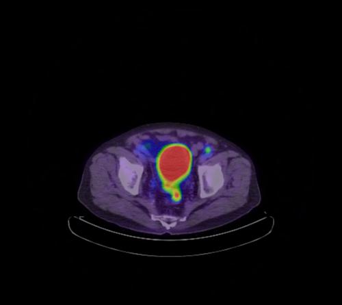 Abdominal wall metastasis from colorectal carcinoma (Radiopaedia 31016-31719 Axial 31).jpg