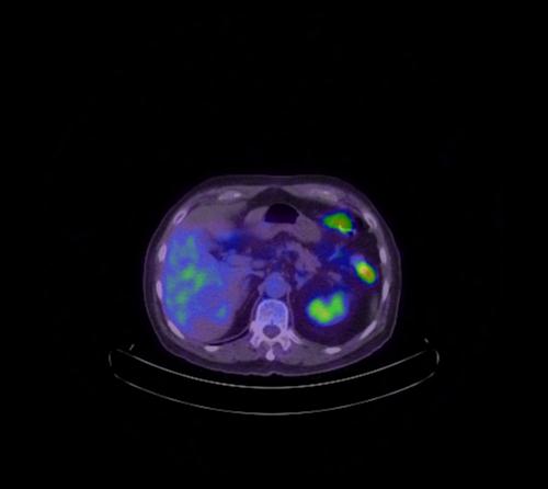 File:Abdominal wall metastasis from colorectal carcinoma (Radiopaedia 31016-31719 Axial 82).jpg