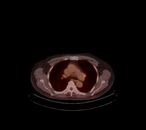 File:Abdominal wall metastasis from colorectal carcinoma (Radiopaedia 31016-31719 C 113).jpg