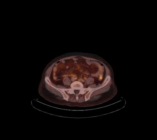 Abdominal wall metastasis from colorectal carcinoma (Radiopaedia 31016-31719 C 46).jpg