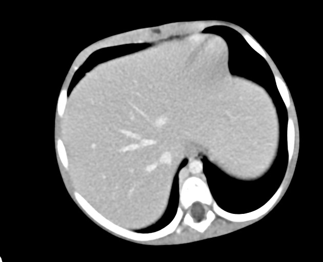 Abdominopelvic rhabdomyosarcoma (Radiopaedia 78356-90984 Axial C+ portal venous phase 41).jpg