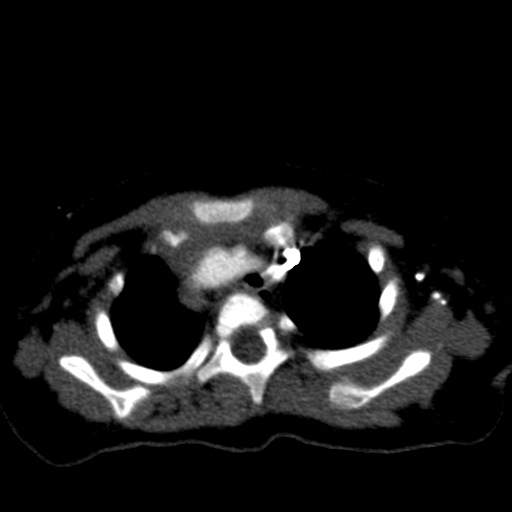 File:Aberrant left pulmonary artery (pulmonary sling) (Radiopaedia 42323-45435 Axial C+ CTPA 12).jpg