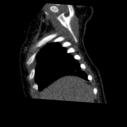 File:Aberrant left pulmonary artery (pulmonary sling) (Radiopaedia 42323-45435 Sagittal C+ arterial phase 6).jpg