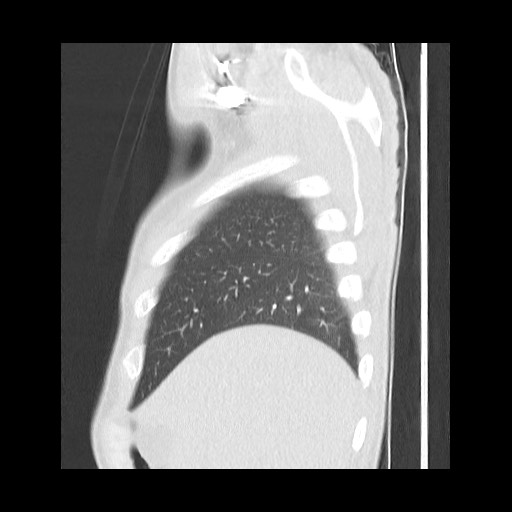 Accessory left horizontal fissure with lingular pneumonia (Radiopaedia 53763-59843 Sagittal lung window 13).jpg