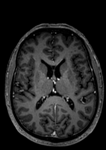 Accessory middle cerebral artery (Radiopaedia 73114-83828 Axial T1 C+ 13).jpg