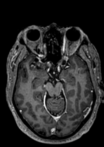 Accessory middle cerebral artery (Radiopaedia 73114-83828 Axial T1 C+ 81).jpg