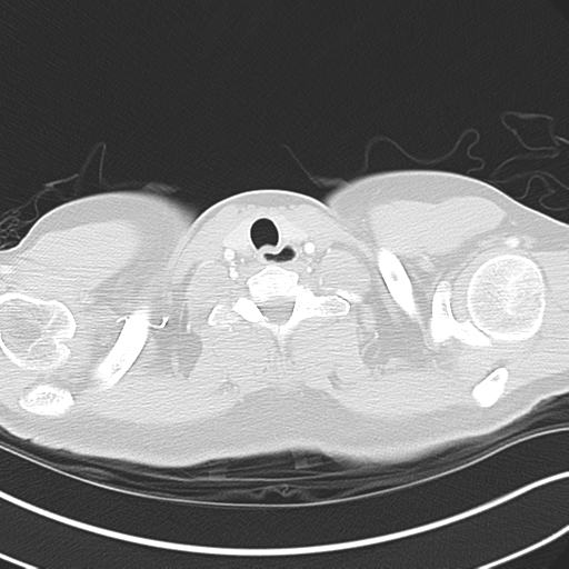 File:Achalasia of the cardia (Radiopaedia 38497-40595 Axial lung window 1).png