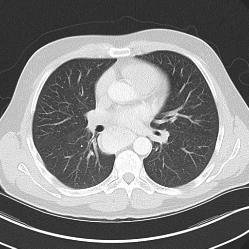 Achalasia of the cardia (Radiopaedia 38497-40595 Axial lung window 27).png