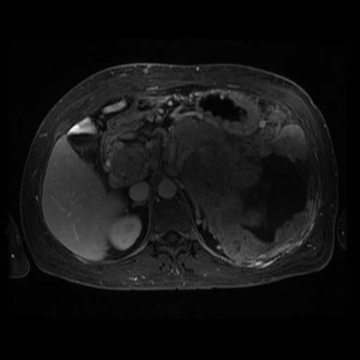 Acinar cell carcinoma of the pancreas (Radiopaedia 75442-86668 D 72).jpg