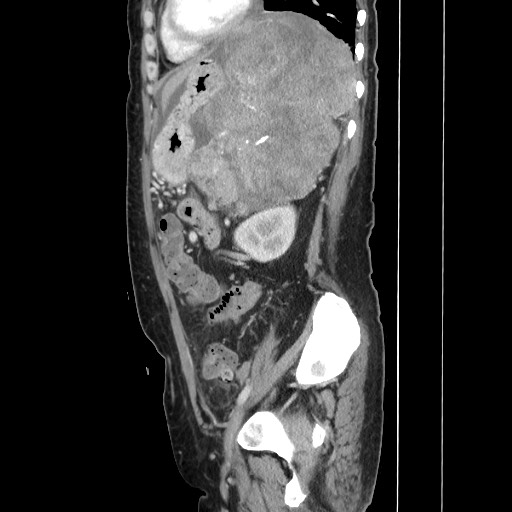 Acinar cell carcinoma of the pancreas (Radiopaedia 75442-86669 Sagittal C+ portal venous phase 132).jpg