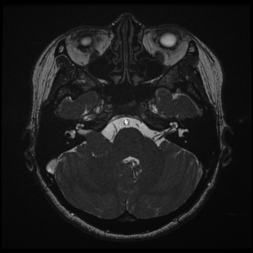 Acoustic neuroma (Radiopaedia 34049-35283 Axial 51).png