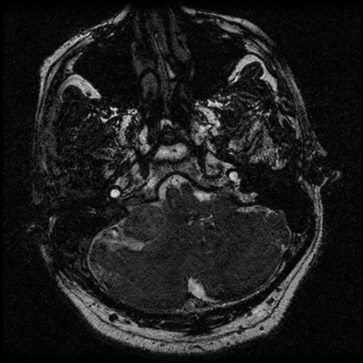 File:Acoustic schwannoma (Radiopaedia 39170-41387 Axial FIESTA 45).png