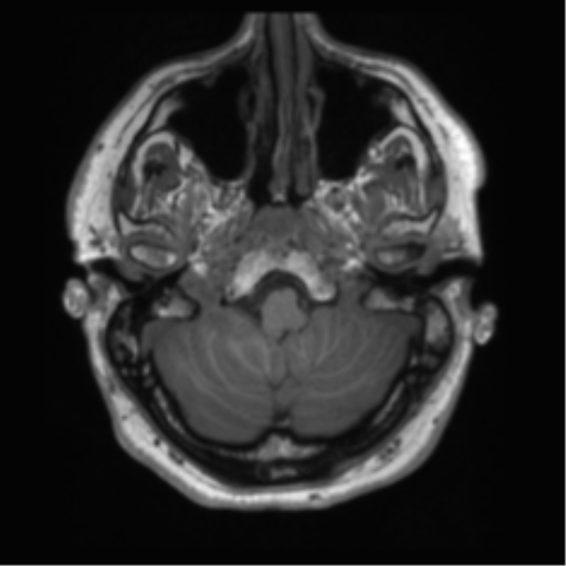 File:Acoustic schwannoma (Radiopaedia 50846-56358 Axial T1 7).png
