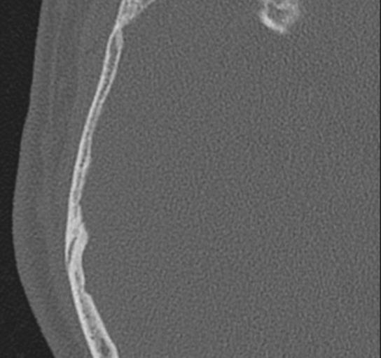Acoustic schwannoma - cystic (Radiopaedia 29487-29980 AXIAL RIGHT bone window 2).jpg