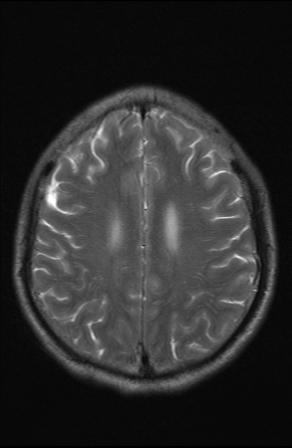 File:Acoustic schwannoma - probable (Radiopaedia 20386-20292 Axial T2 14).jpg