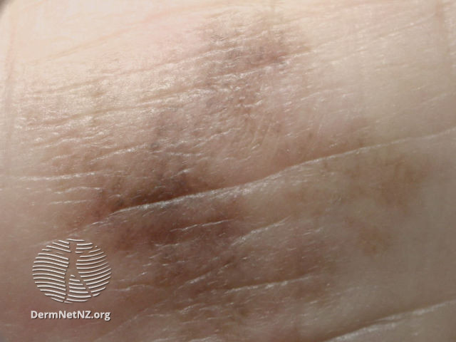 File:Acral lentiginous melanoma (DermNet NZ ALM-macro).jpg