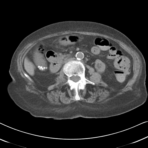 Active bleeding from duodenal ulcer with embolization (Radiopaedia 34216-35481 Axial non-contrast 30).png