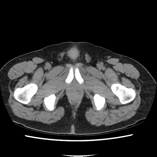 File:Active colonic bleed on CT (Radiopaedia 49765-55025 Axial non-contrast 87).jpg