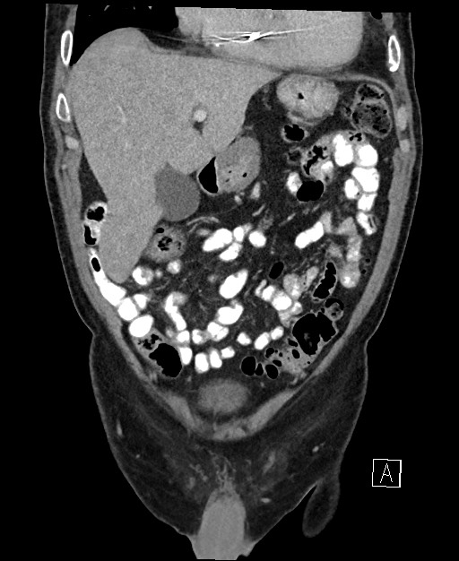 Active lower gastrointestinal bleeding - diverticular (Radiopaedia 61203-69106 Coronal C+ portal venous phase 40).jpg