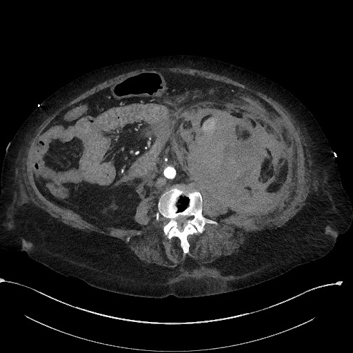 File:Active renal extravasation with large subcapsular and retroperitoneal hemorrhage (Radiopaedia 60975-68796 Axial 19).jpg