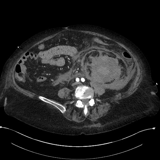 Active renal extravasation with large subcapsular and retroperitoneal hemorrhage (Radiopaedia 60975-68796 Axial C+ arterial phase 117).jpg