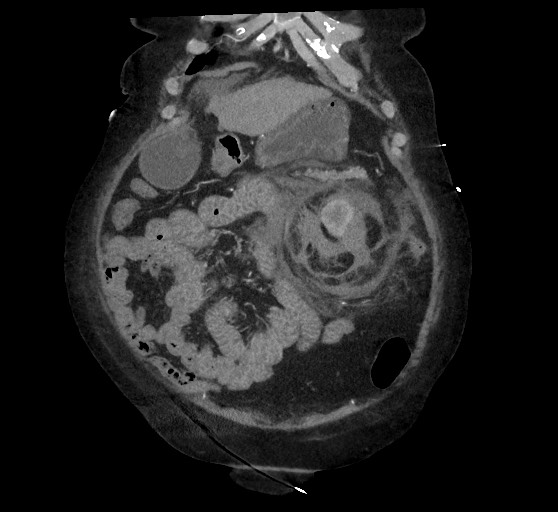 Active renal extravasation with large subcapsular and retroperitoneal hemorrhage (Radiopaedia 60975-68796 Coronal C+ arterial phase 42).jpg