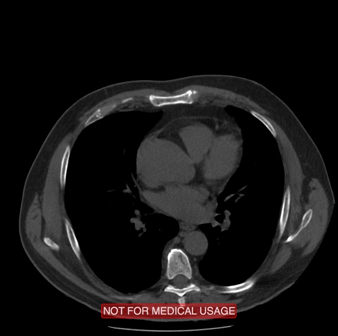 Acute aortic dissection - Stanford type A (Radiopaedia 40661-43285 Axial non-contrast 32).jpg