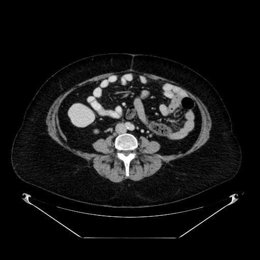 File:Acute appendicitis, heterotaxy syndrome (Radiopaedia 66884-76202 Axial 1).jpg