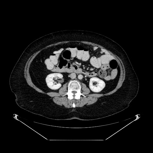 Acute appendicitis, heterotaxy syndrome (Radiopaedia 66884-76202 Axial C+ portal venous phase 62).jpg