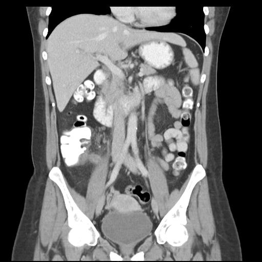 Acute appendicitis (Radiopaedia 30297-30934 Coronal C+ portal venous phase 22).jpg