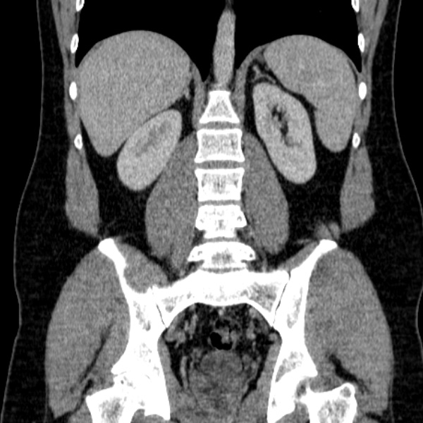 Acute appendicitis (Radiopaedia 38255-40270 Coronal C+ portal venous phase 58).jpg