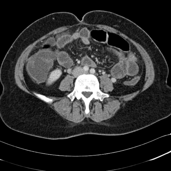 Acute appendicitis (Radiopaedia 48792-53822 Axial C+ portal venous phase 68).jpg