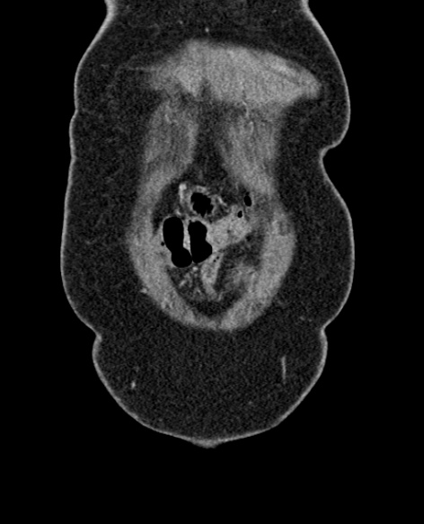 File:Acute appendicitis (Radiopaedia 48792-53822 Coronal C+ portal venous phase 25).jpg